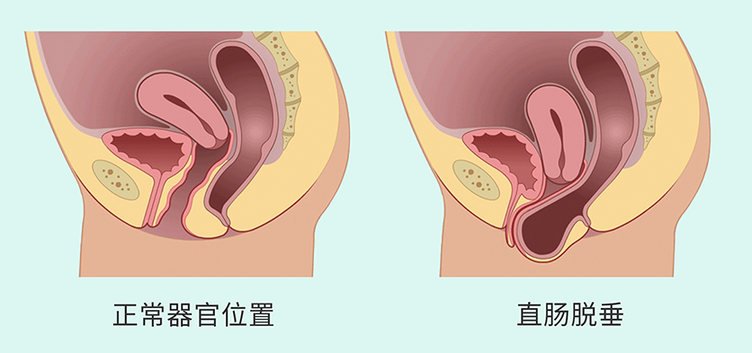 盆腔臟器脫垂3.png