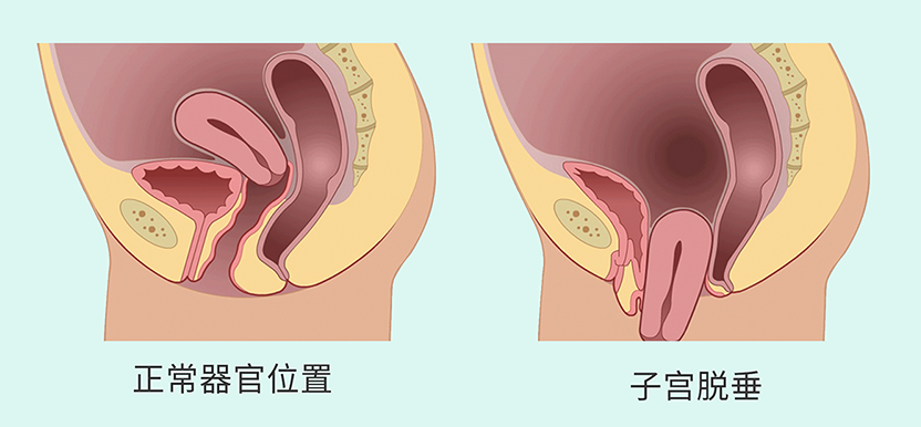 盆腔臟器脫垂4.png