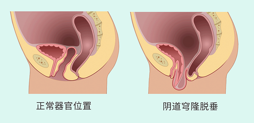 盆腔臟器脫垂5.png