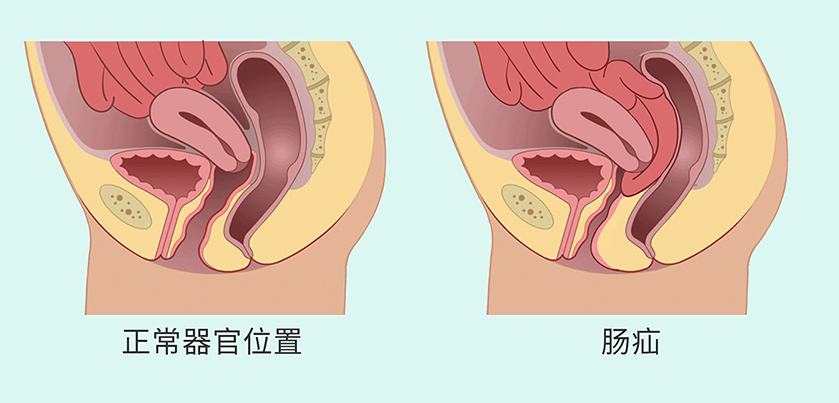 盆腔臟器脫垂6.png